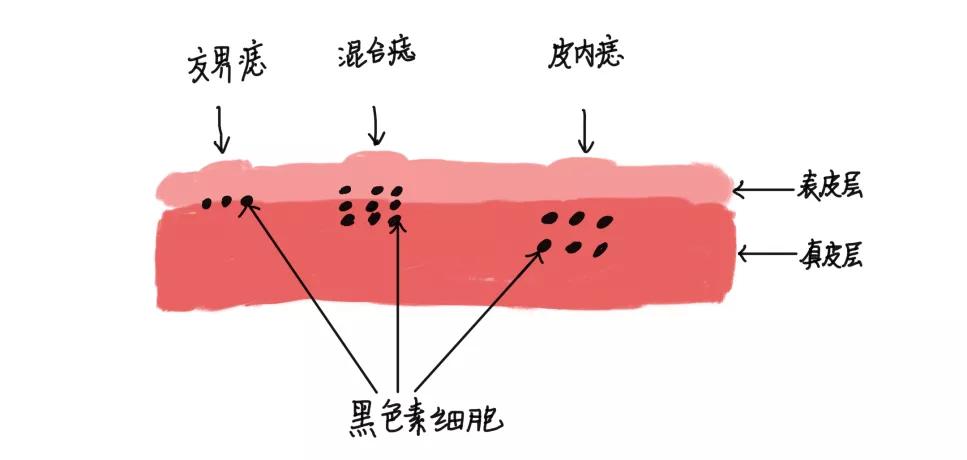 如何去除色素痣过程视频,如何干掉黑色素