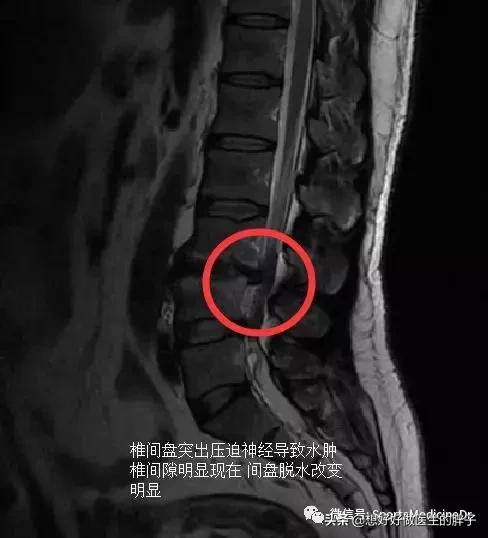 做仰卧起坐真的会腰椎间盘突出吗,仰卧起坐会导致腰椎间盘突出吗