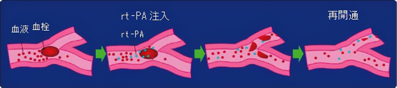 脑梗前兆一定牢记这几点能自救,脑梗康复十大注意事项