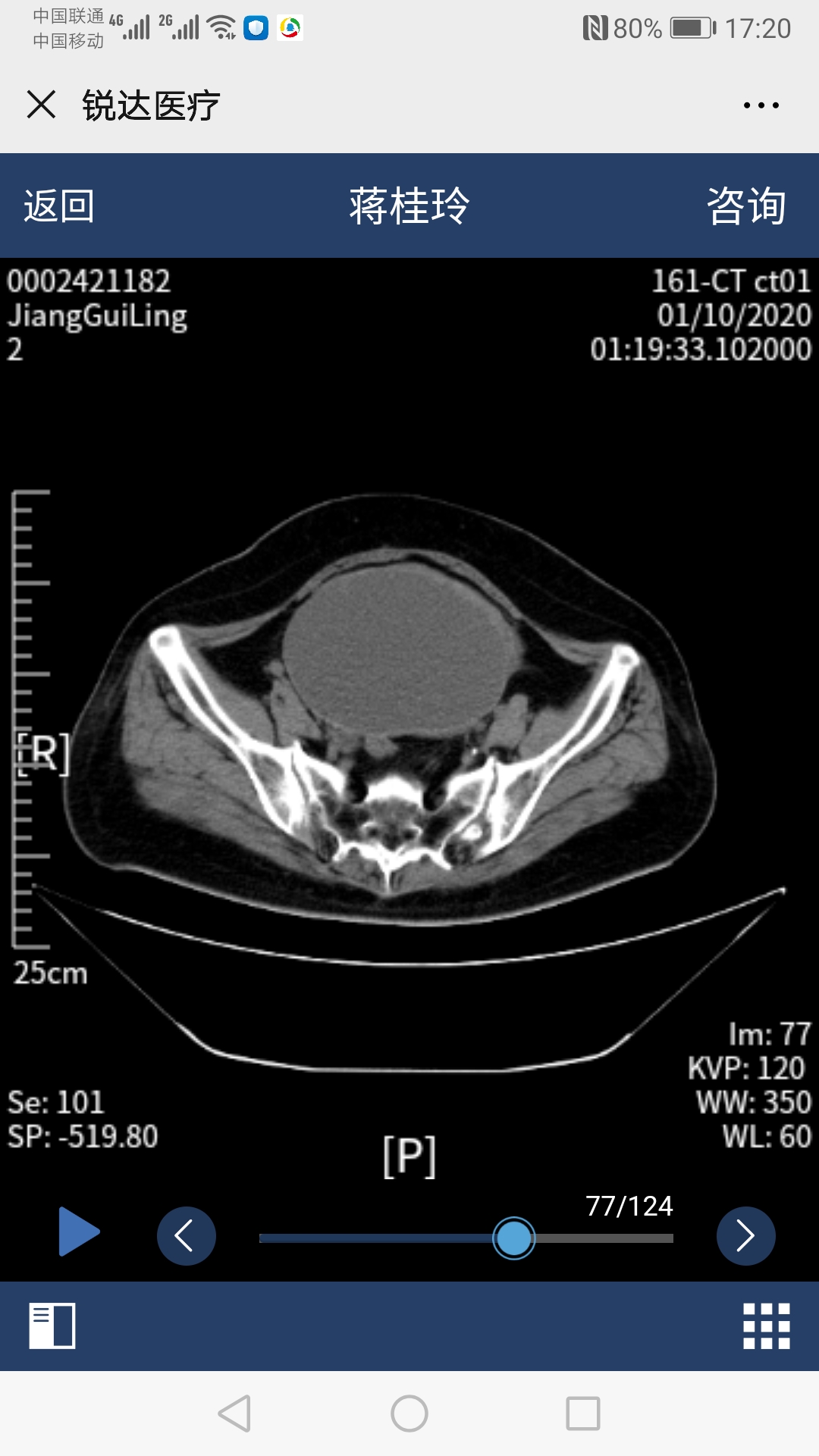 鍏堝績鐥呭悎骞舵紡鏂楄兏鎵嬫湳,瀹吂鑱斿悎鍥婅偪鎵嬫湳