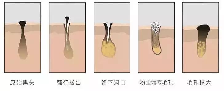 黑头闭口连根拔起,黑头粉刺连根拔起留坑