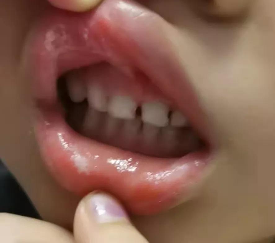 幼儿嘴里鹅口疮怎么办,幼儿园为什么很多孩子得手足口病