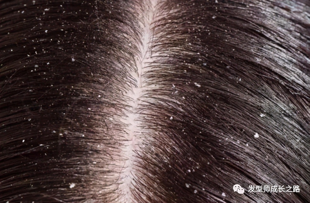 头皮屑的真正原因,头皮屑基础了解