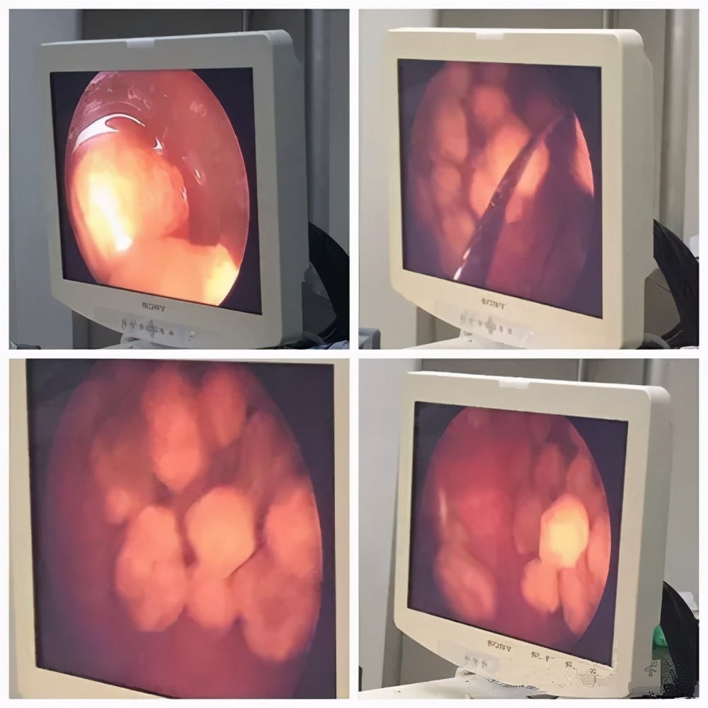 女子常年不吃早餐就医查出胆结石,不爱喝水十岁女孩长出数颗胆结石