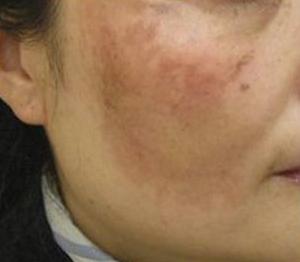 30岁以后脸上有斑怎么护理,怎样区分脸上的是斑还是痣