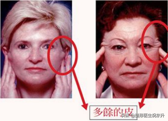 面部除皱手术全过程,面部除皱术的七大类详解