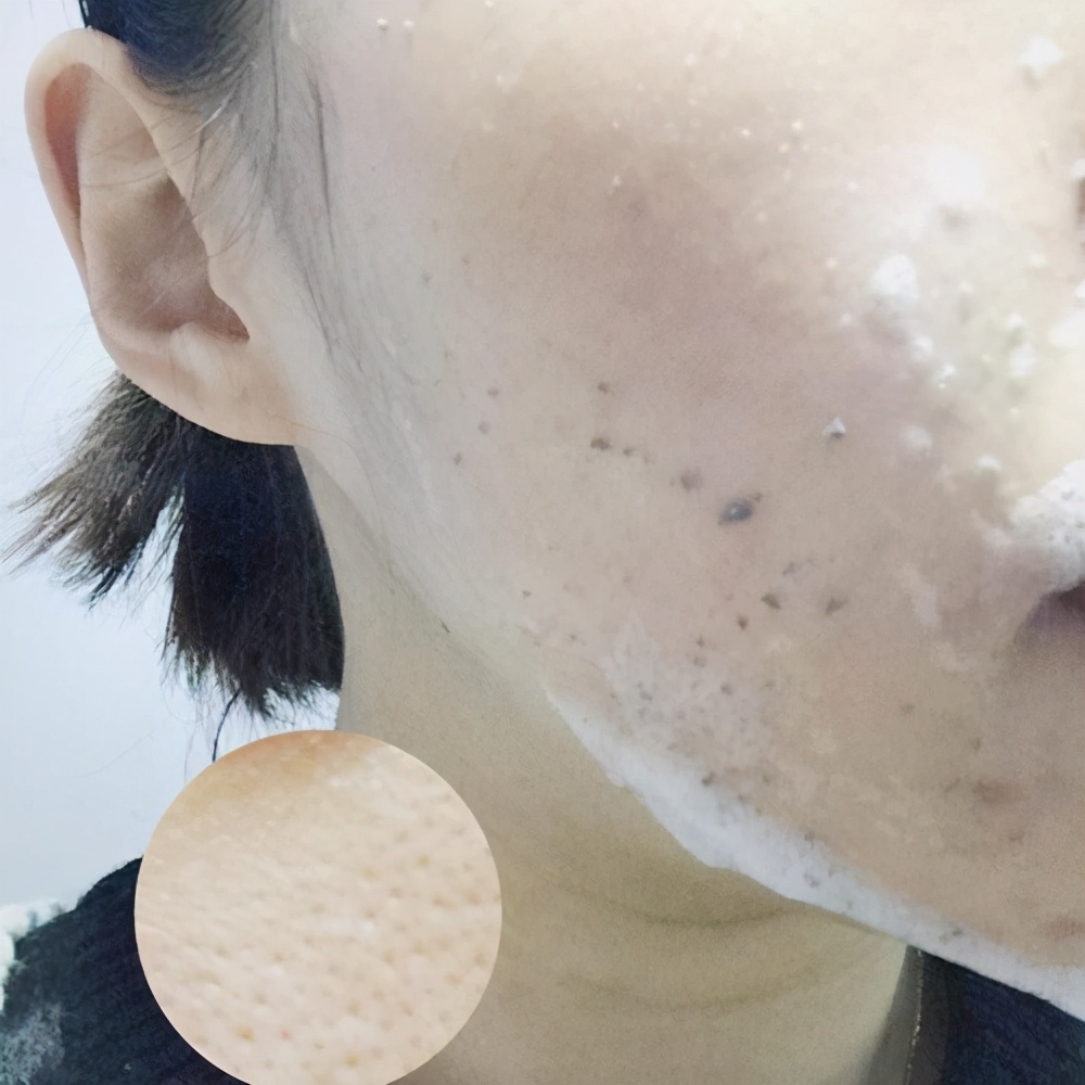 淡化痘印正确护肤步骤,什么东西能淡化痘印又能美白