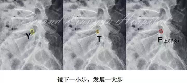 经皮腰椎间盘切除术有何优缺点,什么是经皮内镜腰椎手术