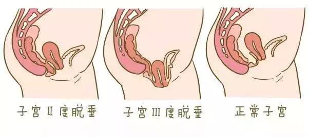 子宫脱垂擦伤了该怎么办,孕期子宫脱垂怎么办