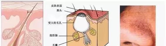 去黑头泥膜正确用法,如何正确去黑头学生党