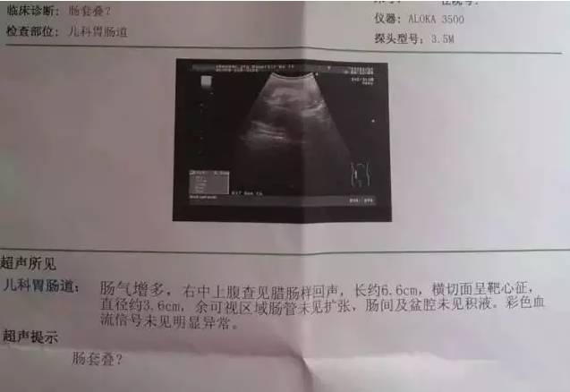 恐怖的肠套叠经历！抓住救命黄金12小时