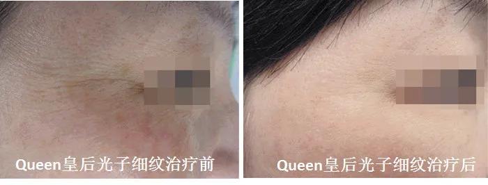 脸部脱毛和光子嫩肤可以一起做吗,油皮光子嫩肤护肤方法