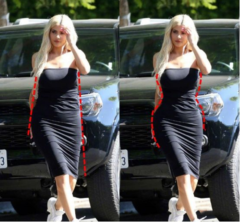 女性腰腹吸脂手术全过程,肥胖的人可以吸脂减肥吗