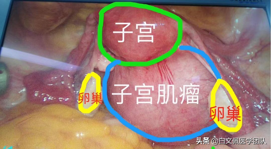 腹腔镜妇科解剖教学视频教程,白文佩医学团队