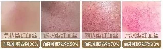 红血丝的原因你找到了吗,全面了解红血丝超全知识版