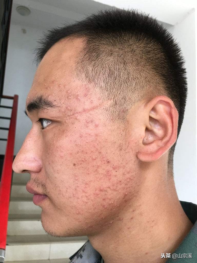 反复痘痘用什么祛痘产品好,祛痘全攻略脸上痘痘真的干净了