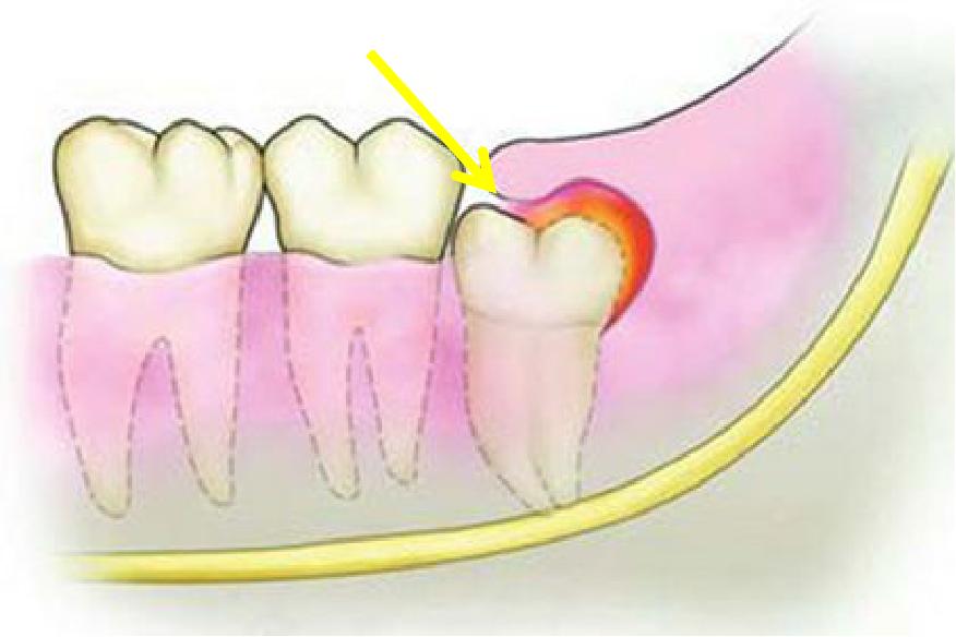 智齿发炎脸肿又感染新冠怎么办,急性智齿发炎脸肿吃什么下火