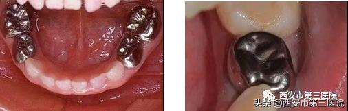 预成冠儿童乳牙内收钳怎么用,乳牙金属预成冠有必要做吗