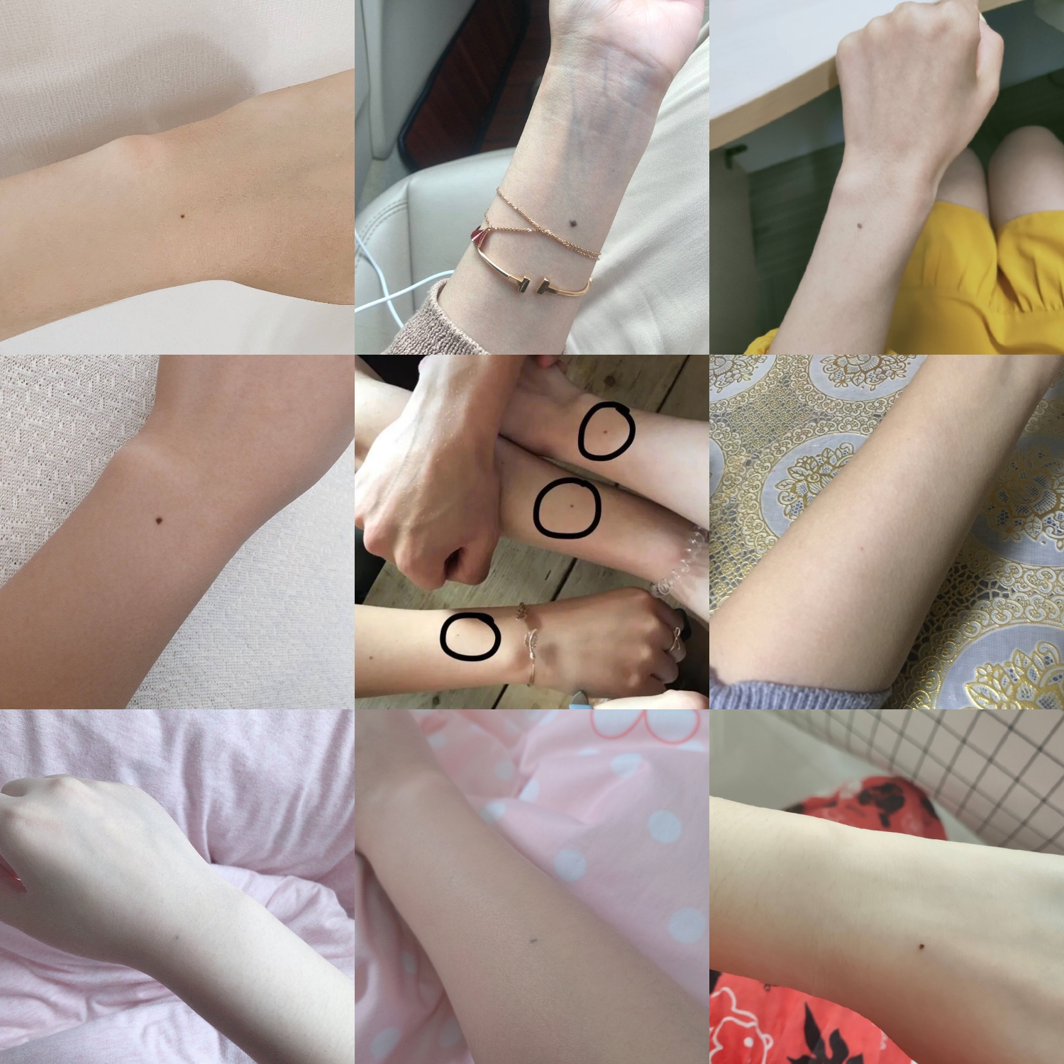 手臂上有一点胎痣是什么预兆,手臂胎记里面有13颗痣代表什么