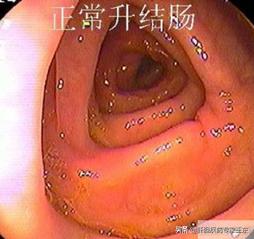 结肠镜检查，痛苦并快乐着