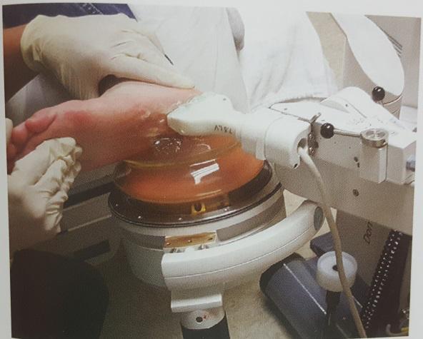 骨刺外翻什么症状,骨刺会导致拇指外翻吗