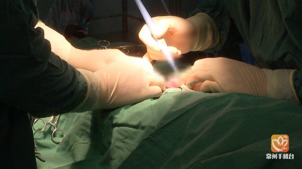 暑假包皮手术多少人,暑假包皮手术多到什么程度