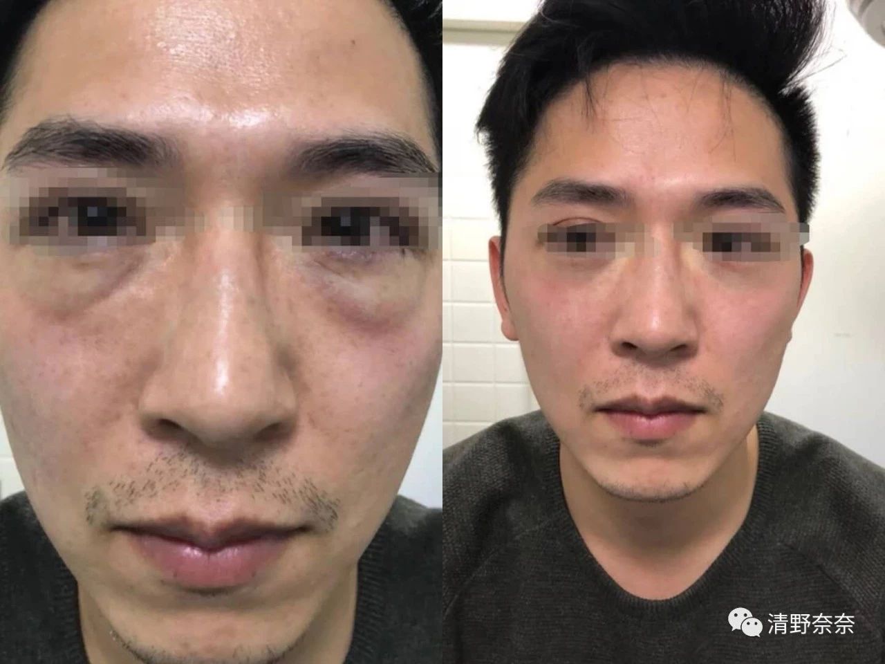 黑眼圈和眼袋可以通过眼霜消除吗,用什么样的眼霜能去除眼袋黑眼圈