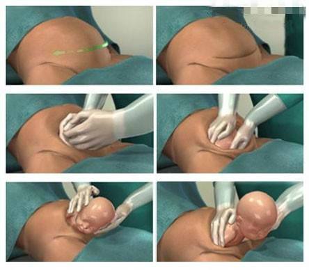 剖腹产二胎刀口是在同一个位置吗,二胎剖宫产刀口