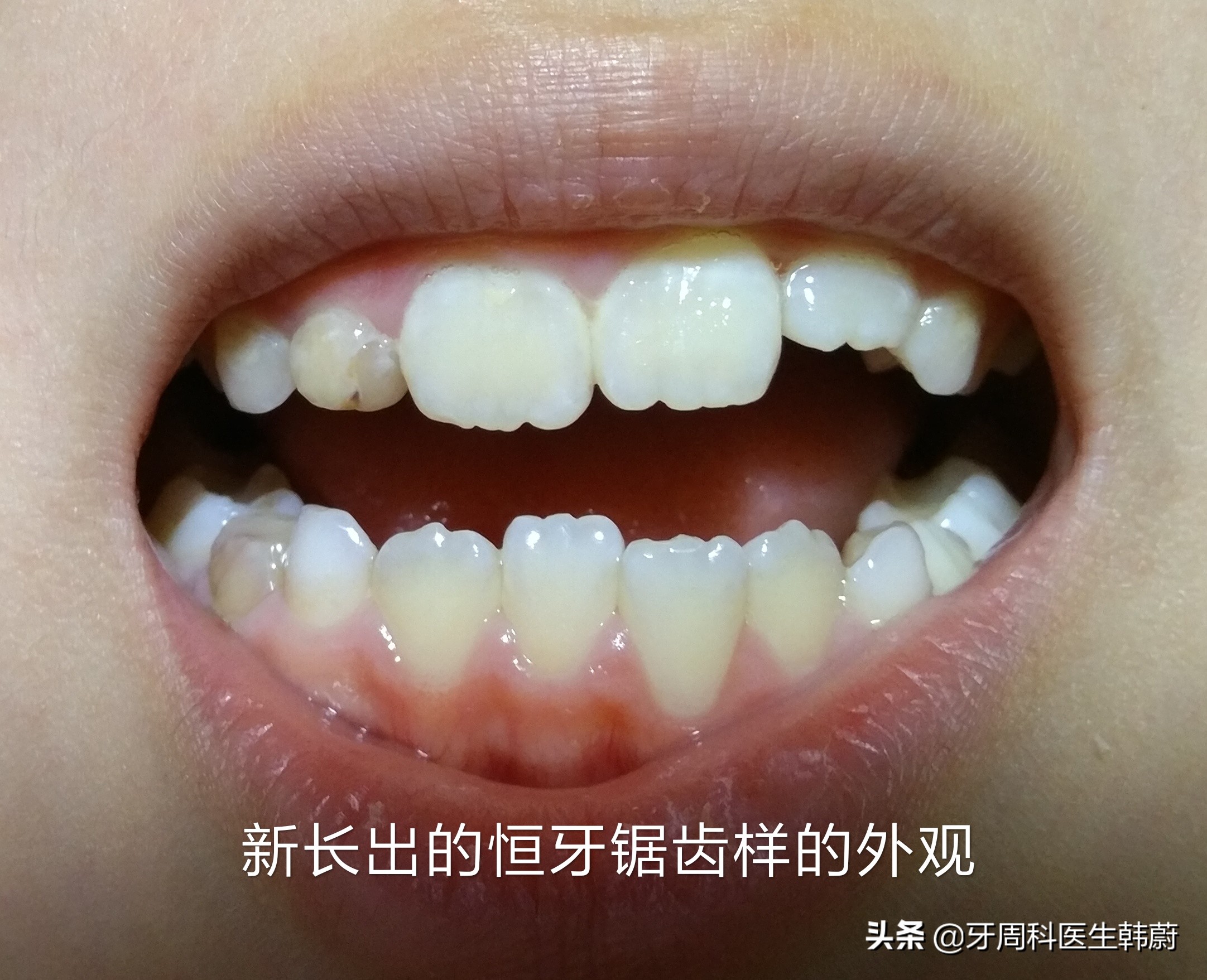 宝宝长双层牙乳牙怎么拔掉,6岁小孩长双层牙必须拔掉吗