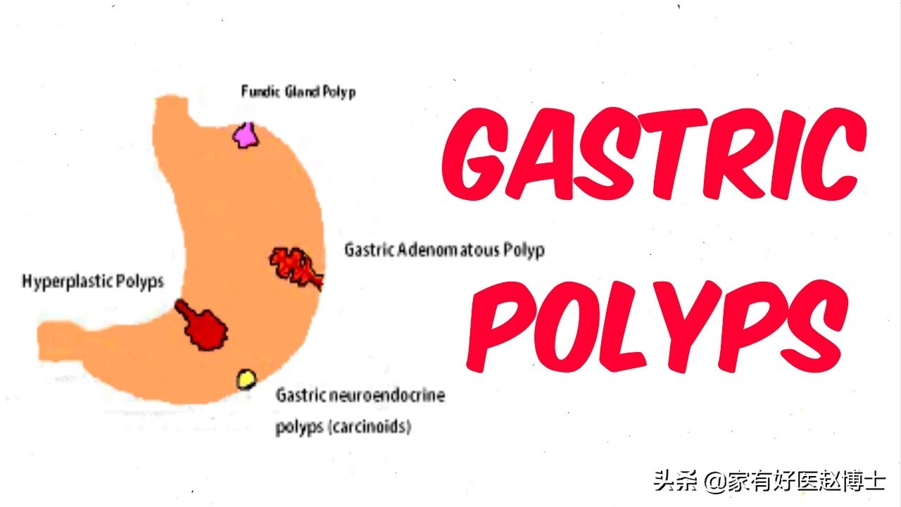 最常见5类息肉每个人都可能有，哪些无癌变风险，哪些需要切除？