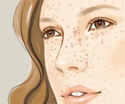 脸上长暗斑怎么办如何快速祛斑,黑褐斑雀斑用什么护肤品