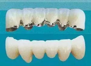 烤瓷牙和全瓷牙的优缺点是什么,钴铬合金烤瓷牙和全瓷牙优缺点