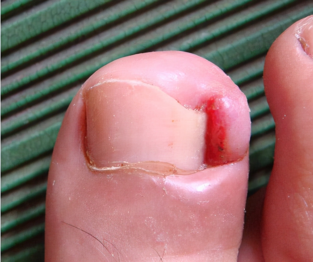 脚趾甲总往肉里“钻”，一碰还疼？学会小妙招，或能告别甲沟炎