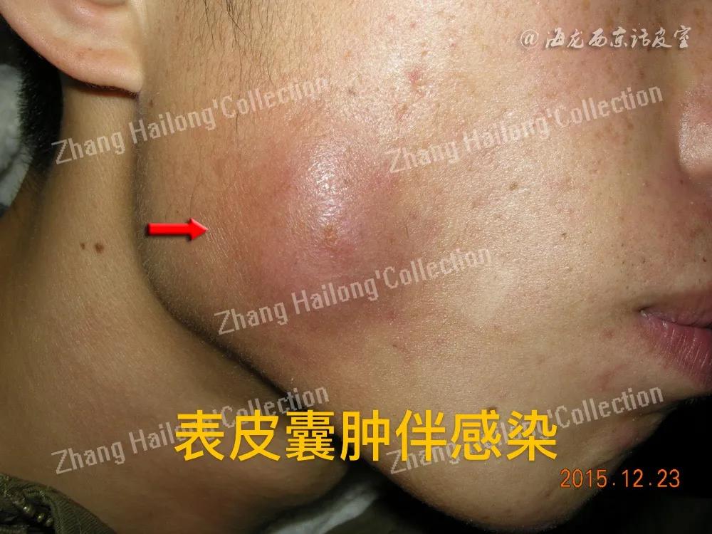 表皮囊肿会引起癌变吗,表皮囊肿是先天性的吗