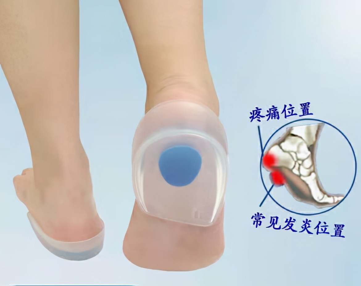脚后跟骨刺一根筷子解决,脚后跟长骨刺是怎么回事