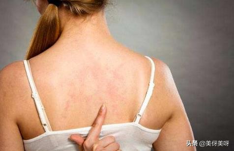 脸上长痘痘前胸长痘痘背后长痘痘,背后长痘痘的原因和改善方法