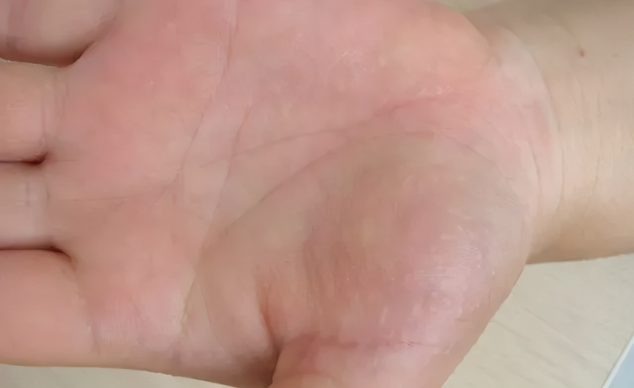 手上起水泡是脚气传染还是汗疱疹,手上长水泡是汗疱疹还是手癣