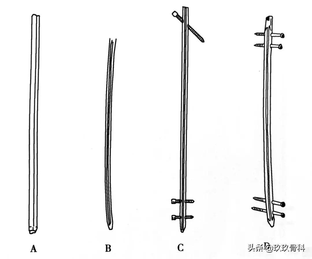骨科用髓内钉什么材料,骨科髓内钉的作用