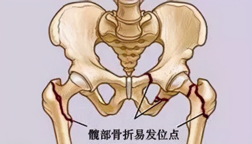 老年人容易得骨折怎么办,老人骨折比较严重的部位