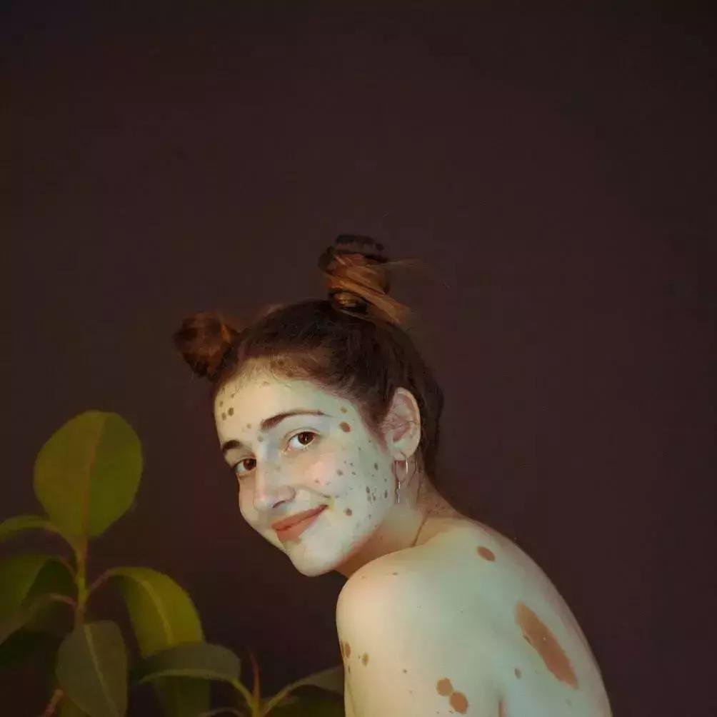 全身黑斑被骂“斑点狗”，身高160的她却成为最美超模…