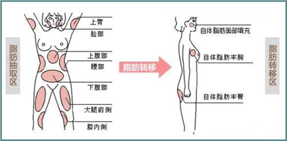 自体脂肪填充全脸逆袭,自体脂肪填充的真相来了