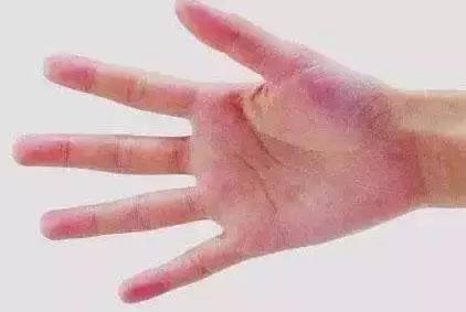 血痣一定是肝癌的征兆,哪种痣可能是肝癌的信号