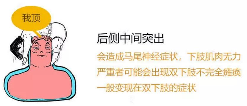 此文章让你彻底明白什么是：腰间盘突出