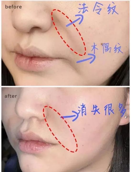 杨紫近照曝光无修图法令纹很深,杨紫面部填充法令纹