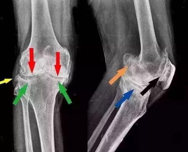 类风湿性关节炎和老寒腿一样么,老寒腿风湿关节炎