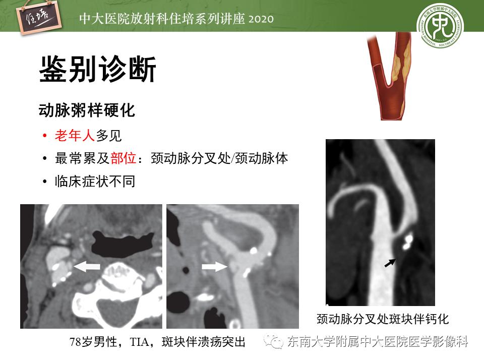 颈动脉夹层的超声表现及漏诊分析,动脉夹层与夹层动脉瘤是一样的吗