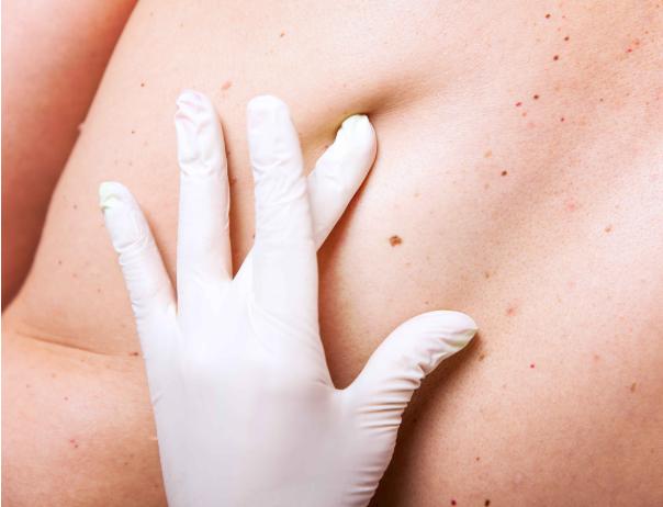 肝不好后背大面积起红斑,肝不好皮肤小红斑