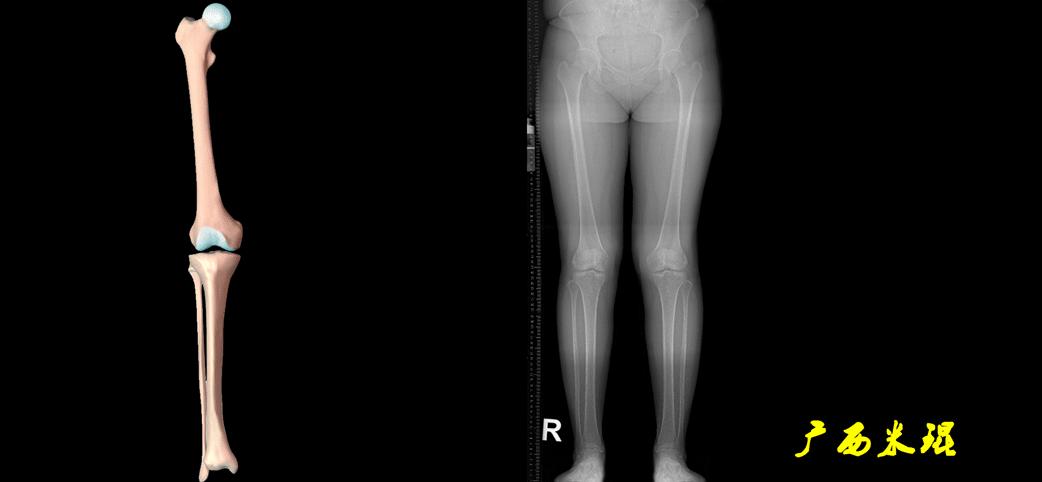 广西骨科医生米琨最新信息,米琨广西骨科什么水平