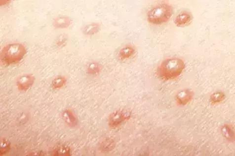 春季是各种传染病的高发季,春季是传染病的高发期吗