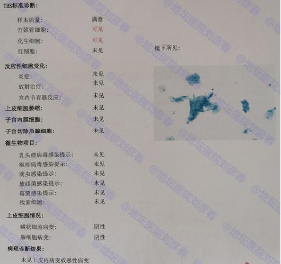 tct炎症反应性细胞改变需要治疗吗,宫颈tct显示重度炎症需要治疗吗